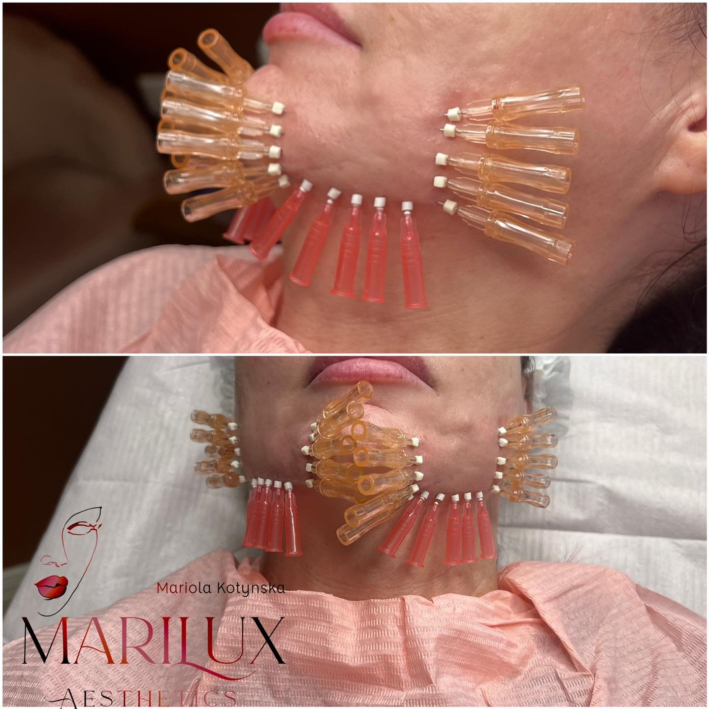 PDOS polydioxanone thread lifting treatment on face