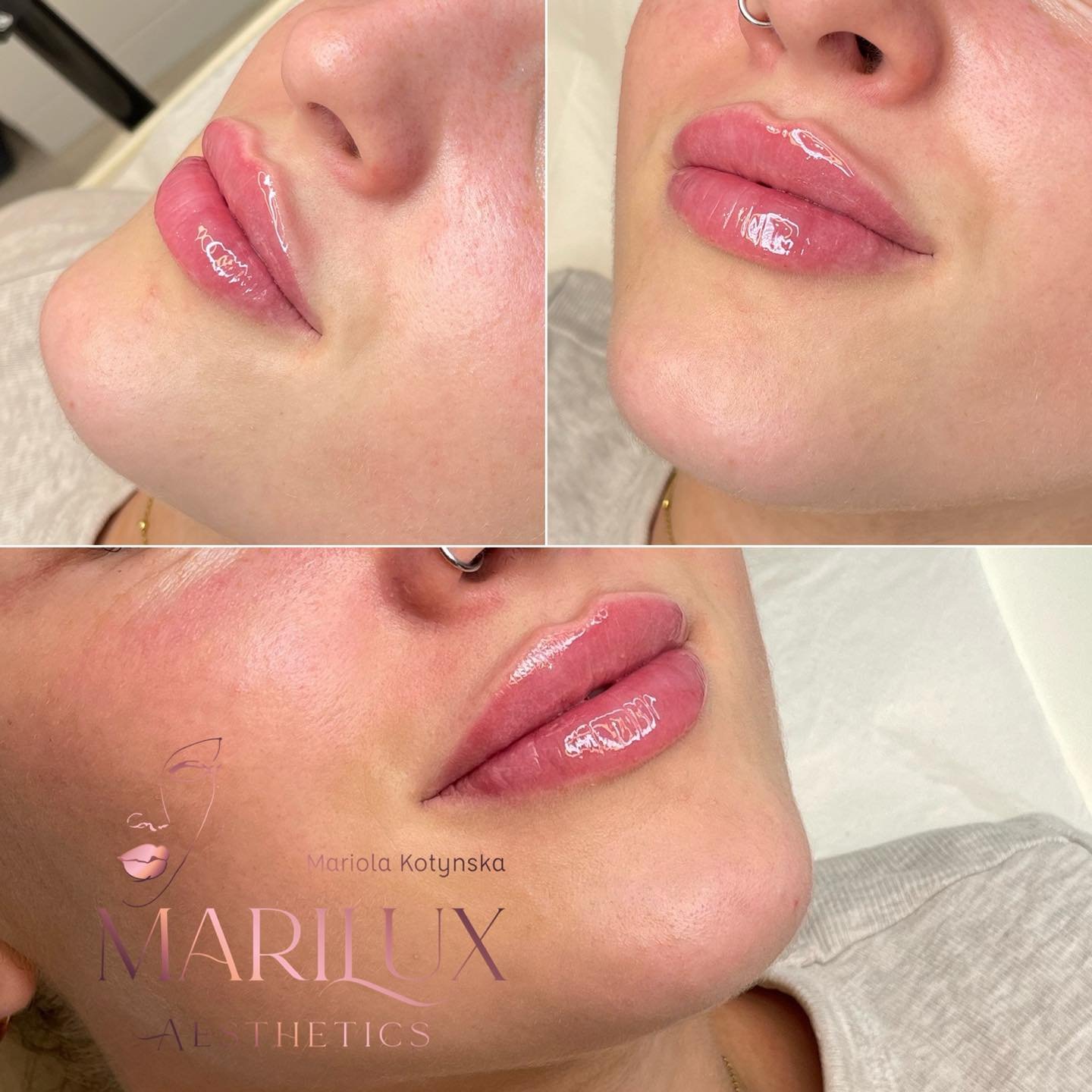 Lip filler results — Marilux Aesthetics