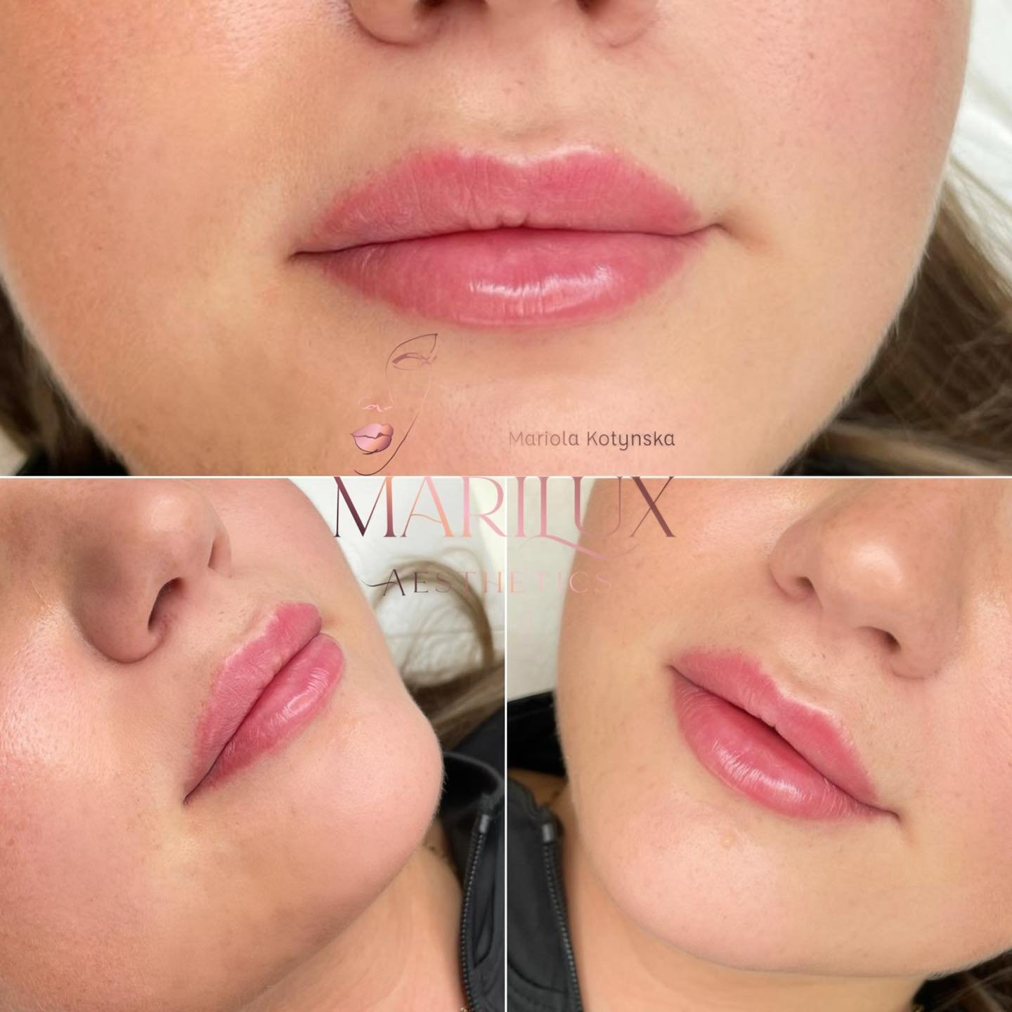 Natural lip enhancement results