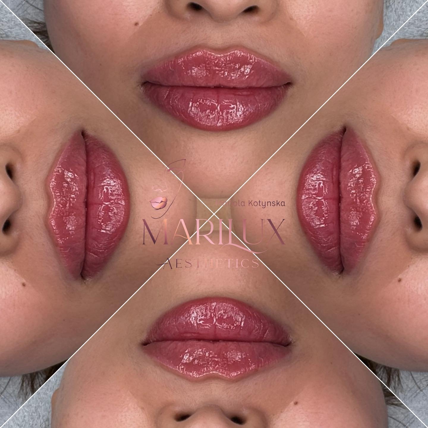Premium lip filler treatments quad collage