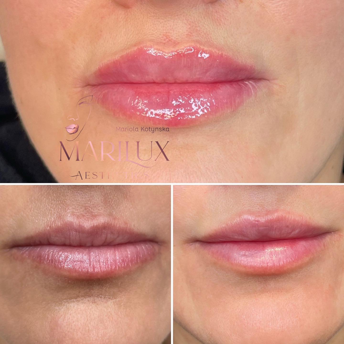 Lip filler result 1 — Marilux Aesthetics